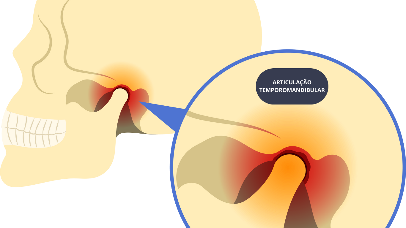 TUDO O QUE VOCÊ PRECISA SABER SOBRE DISFUNÇÃO TEMPOROMANDIBULAR. VOCÊ TEM DTM? VOCÊ SABE O QUE É ?